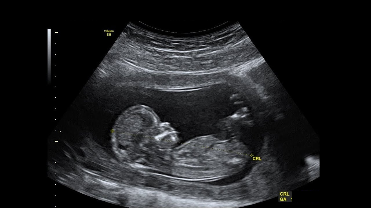 Узи 15 недель беременности пол ребенка фото